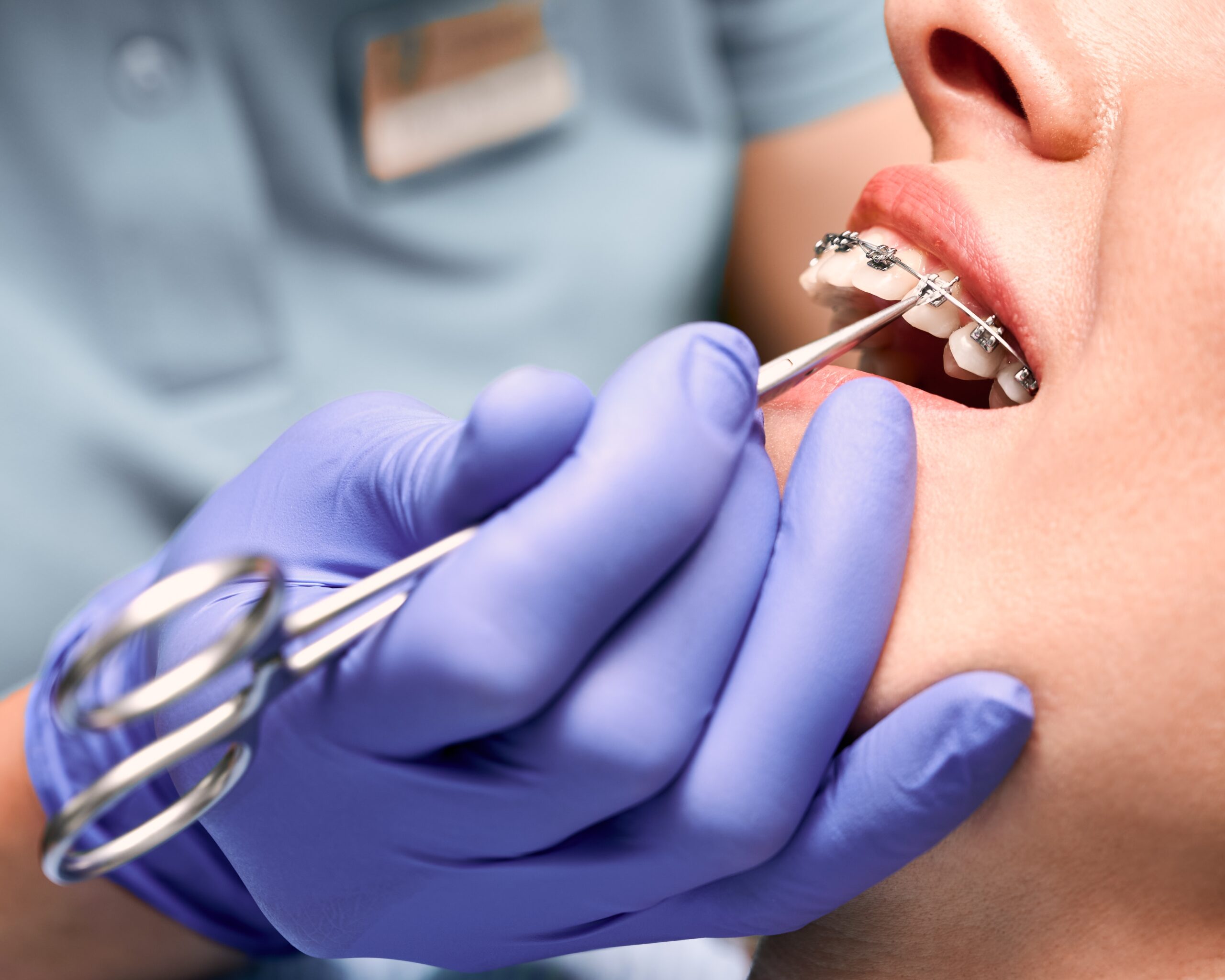 Braces in Huntsville